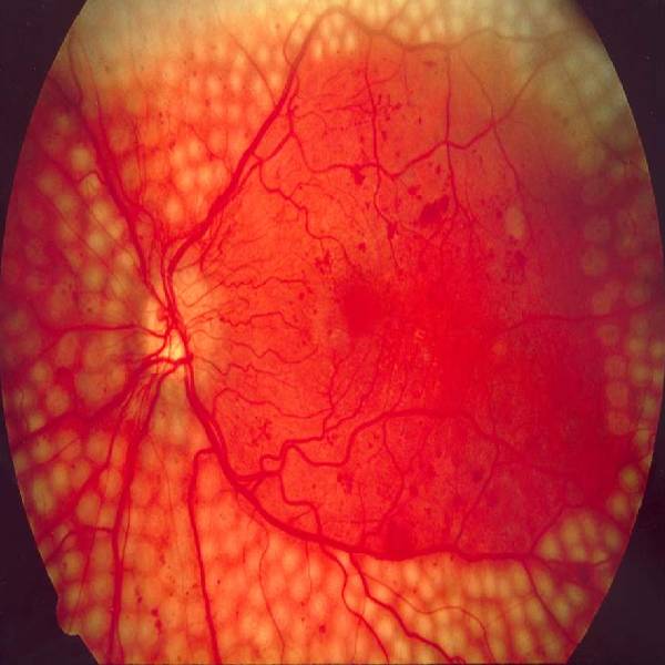 Diabetic Retinopathy